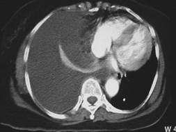 tuberculosis